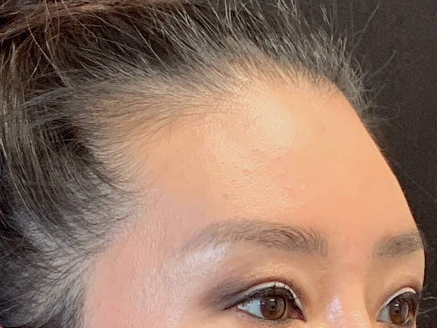 Brow and eyelid lift After Brow and eyelid lift After