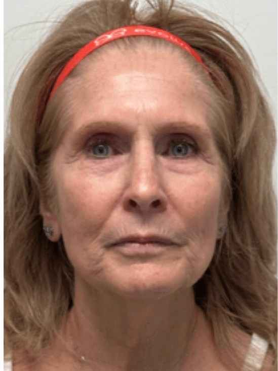 Bellafill dermal filler Before