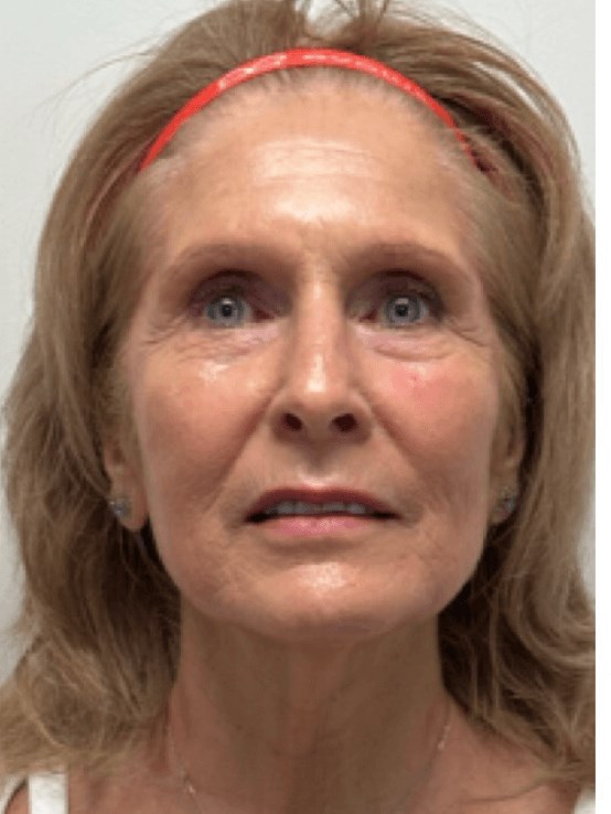 Bellafill dermal filler After