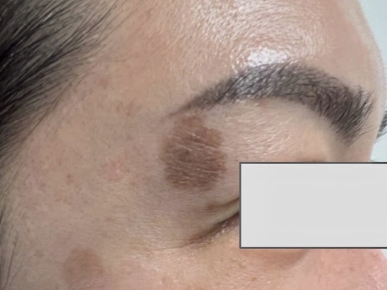 Sun Spot Treatment Before