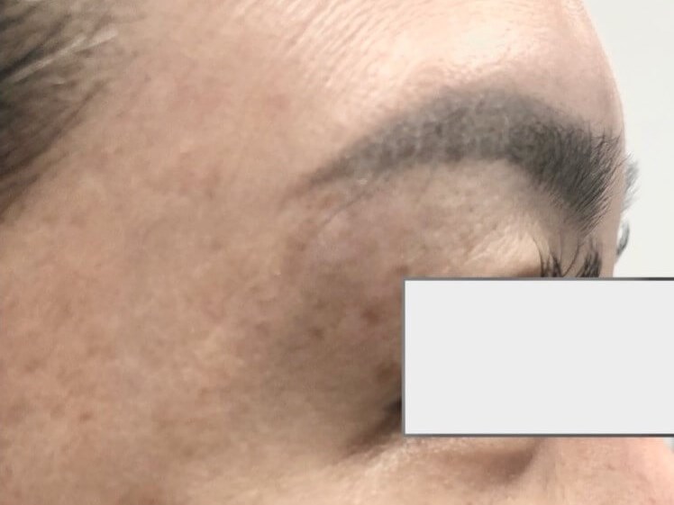 Sun Spot Treatment After