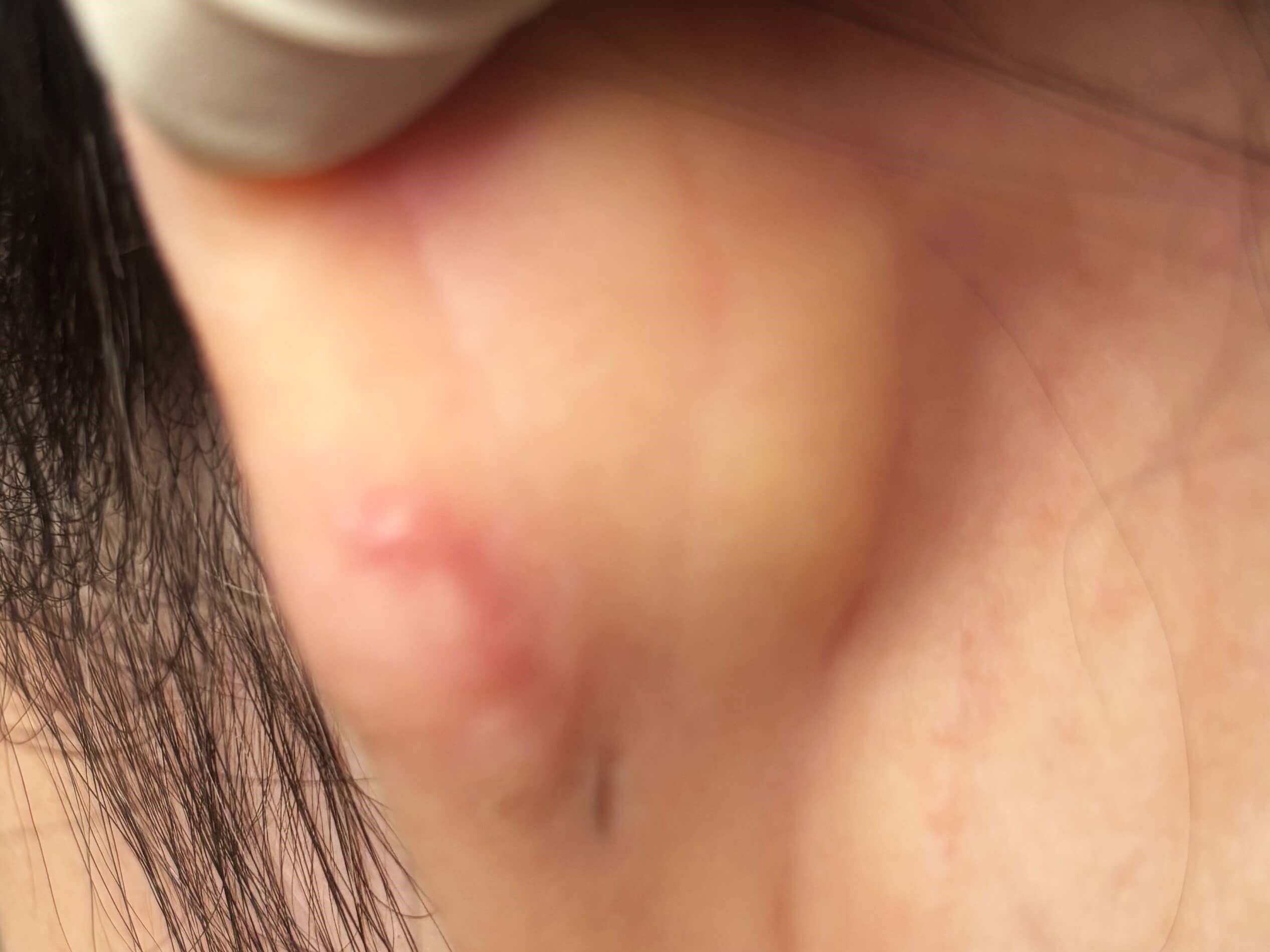 Keloid Removal After