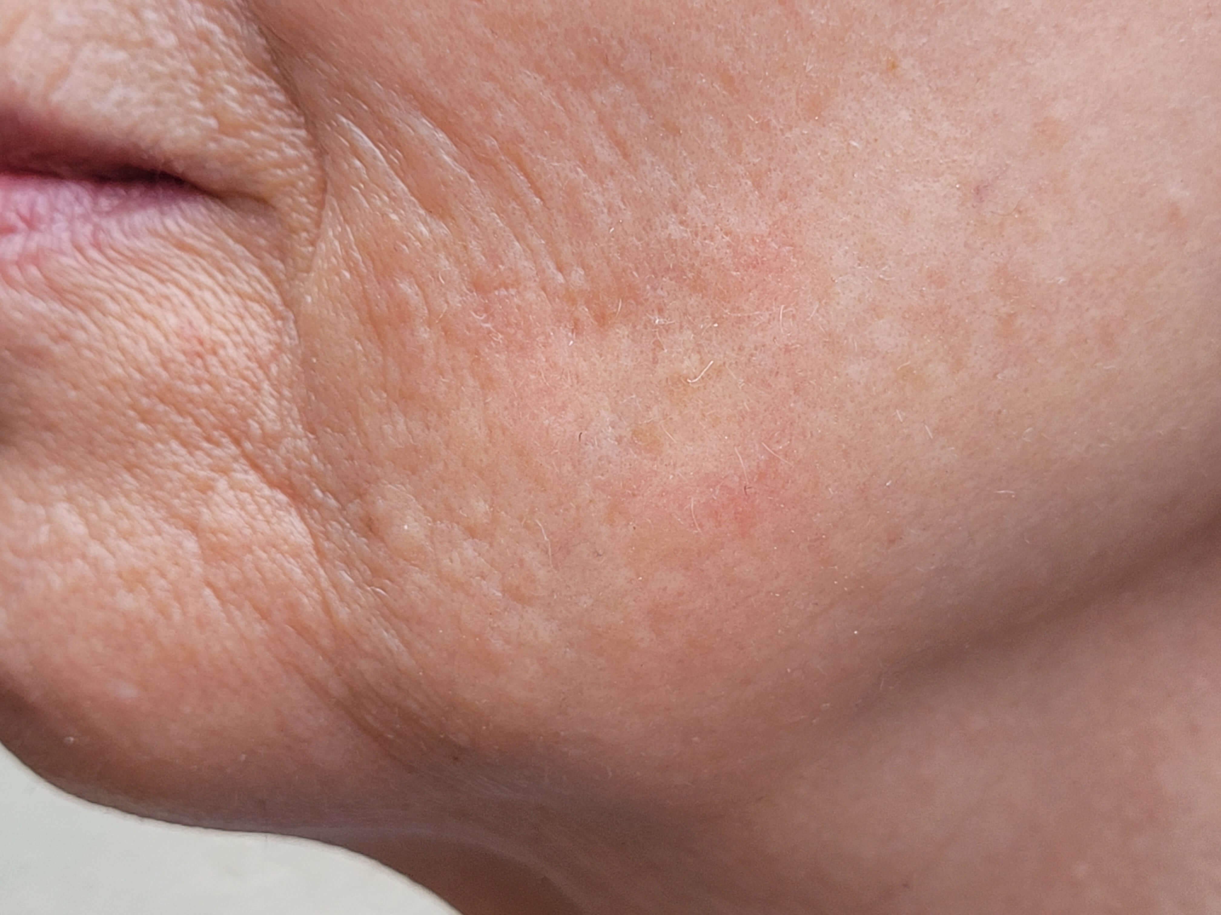 Sunspot/age spot removal After