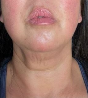 Sofwave Immediate Results Before