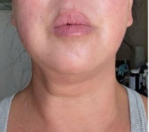 Sofwave Immediate Results Immediately After