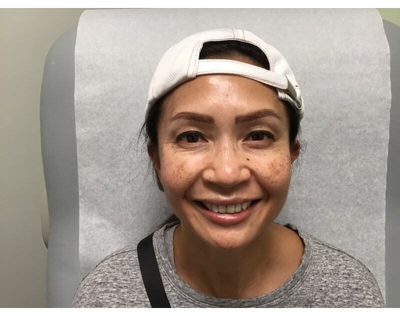 IPL for Hyperpigmentation Before