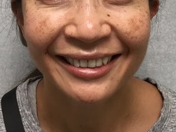 IPL for Hyperpigmentation Before