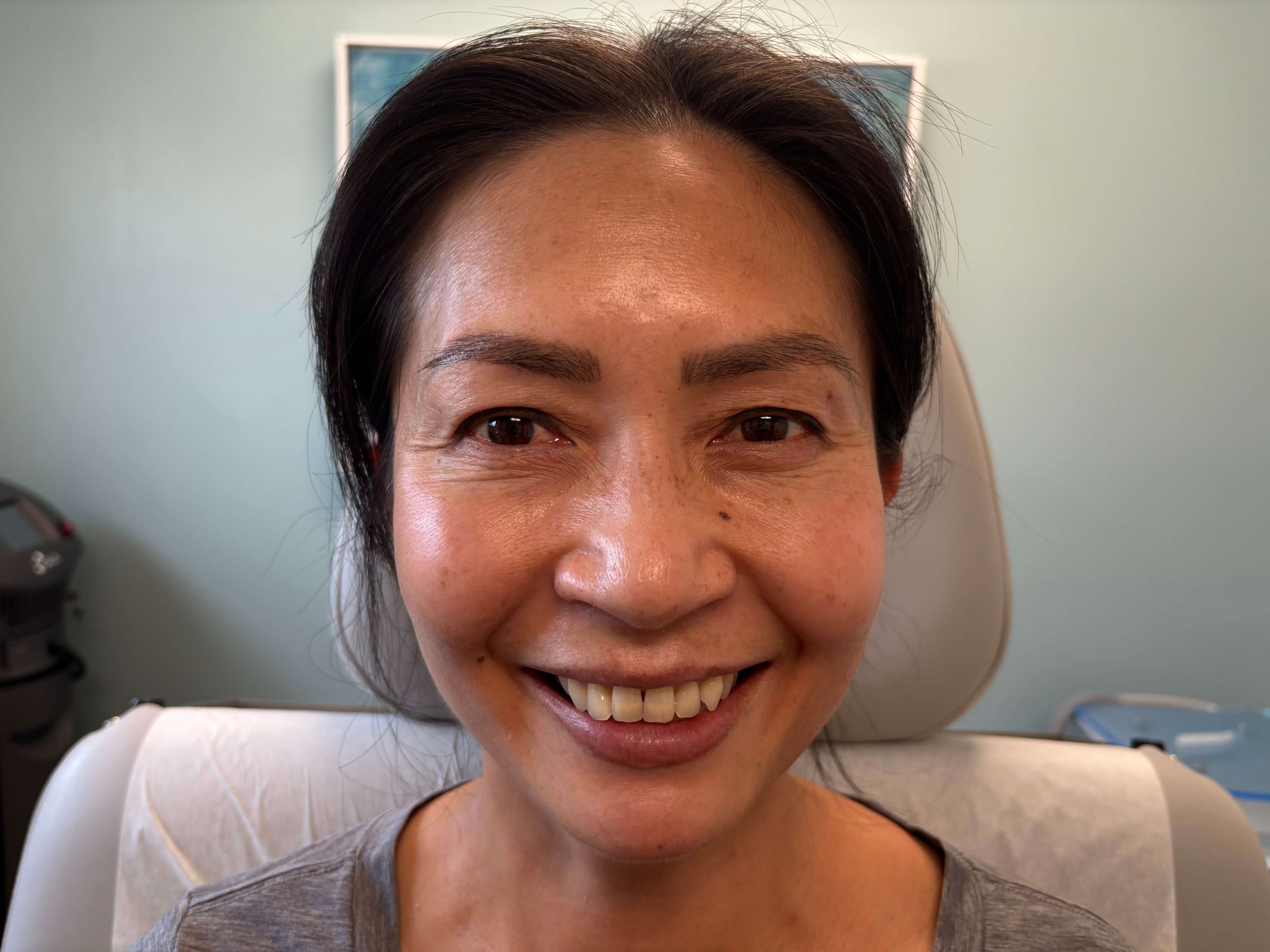 IPL for Hyperpigmentation After