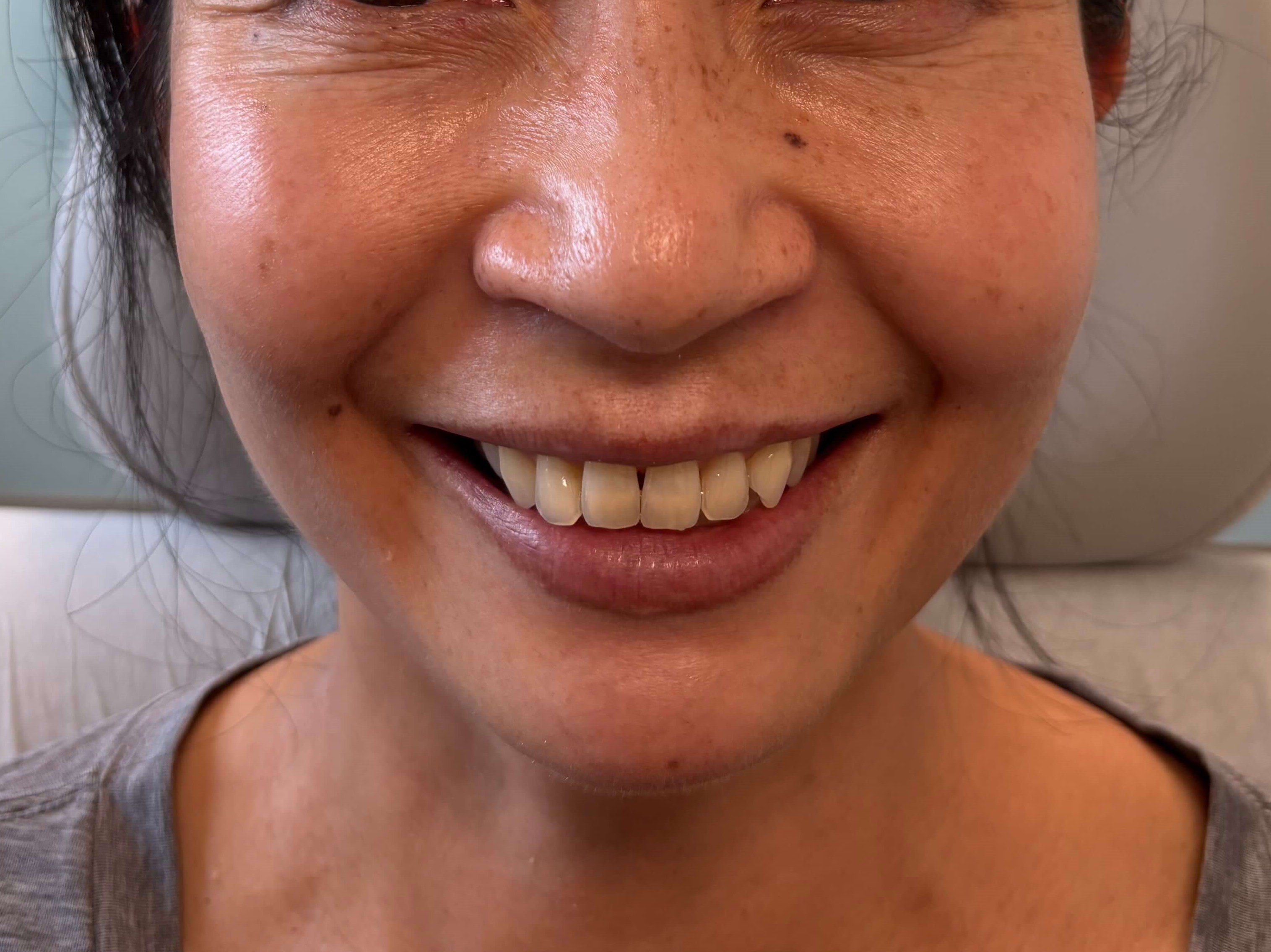 IPL for Hyperpigmentation After