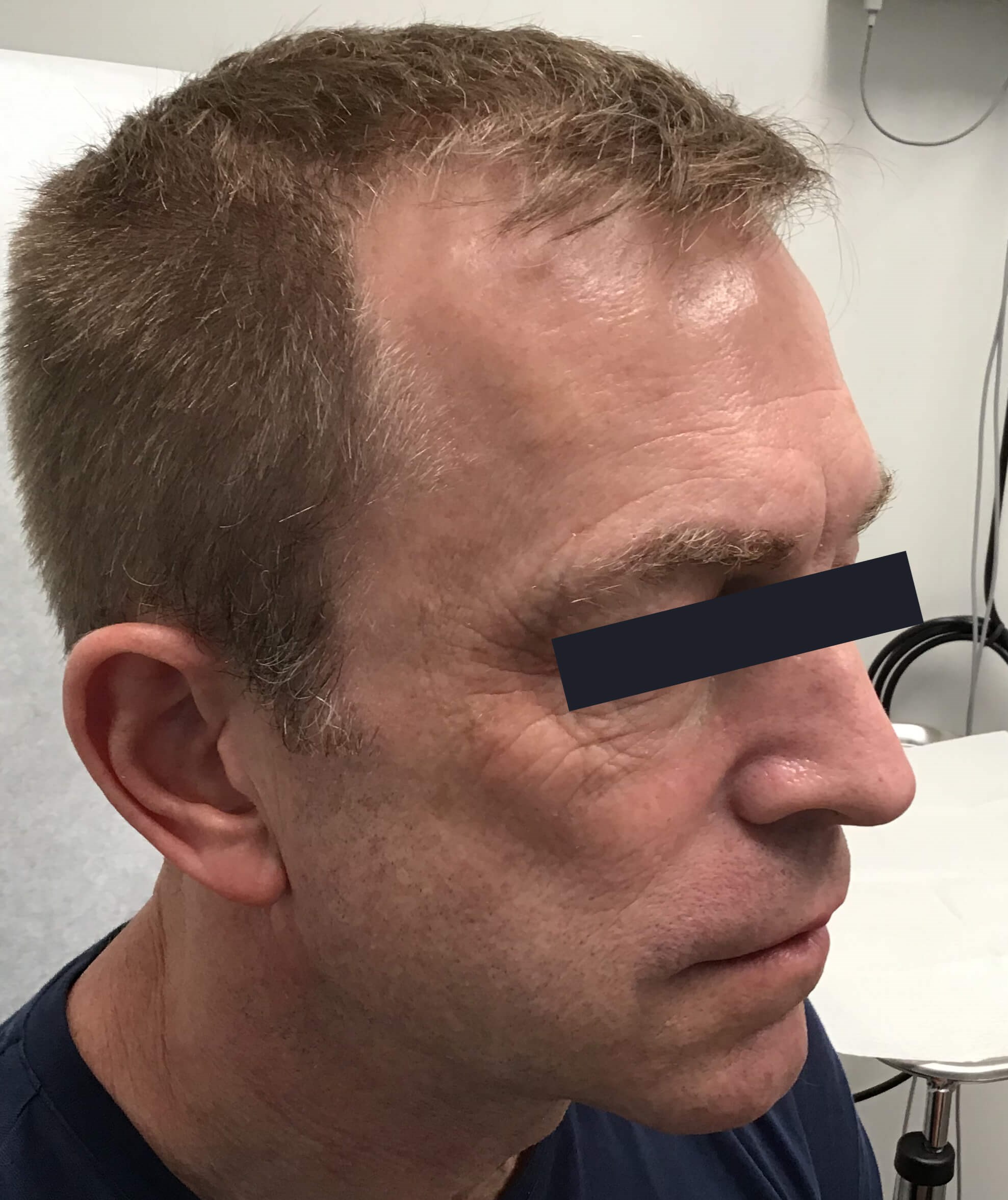 Radiesse Filler Right Eye Before