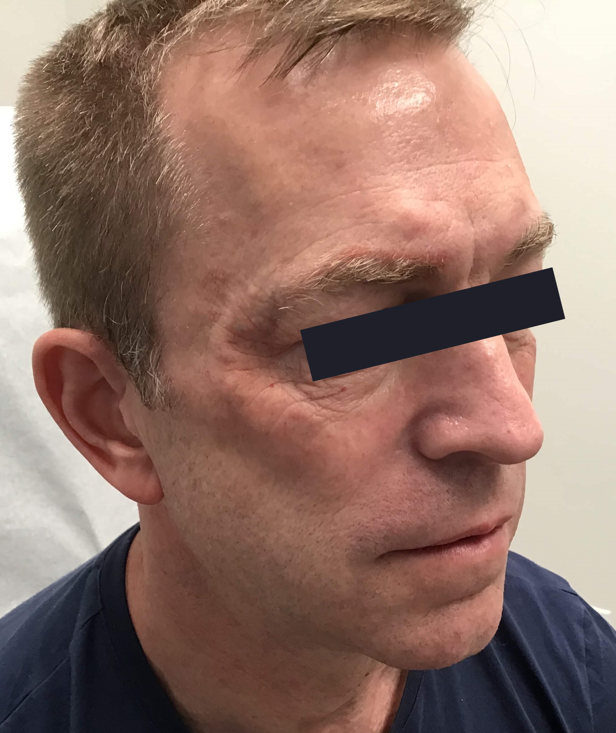 Radiesse Filler Right Eye After