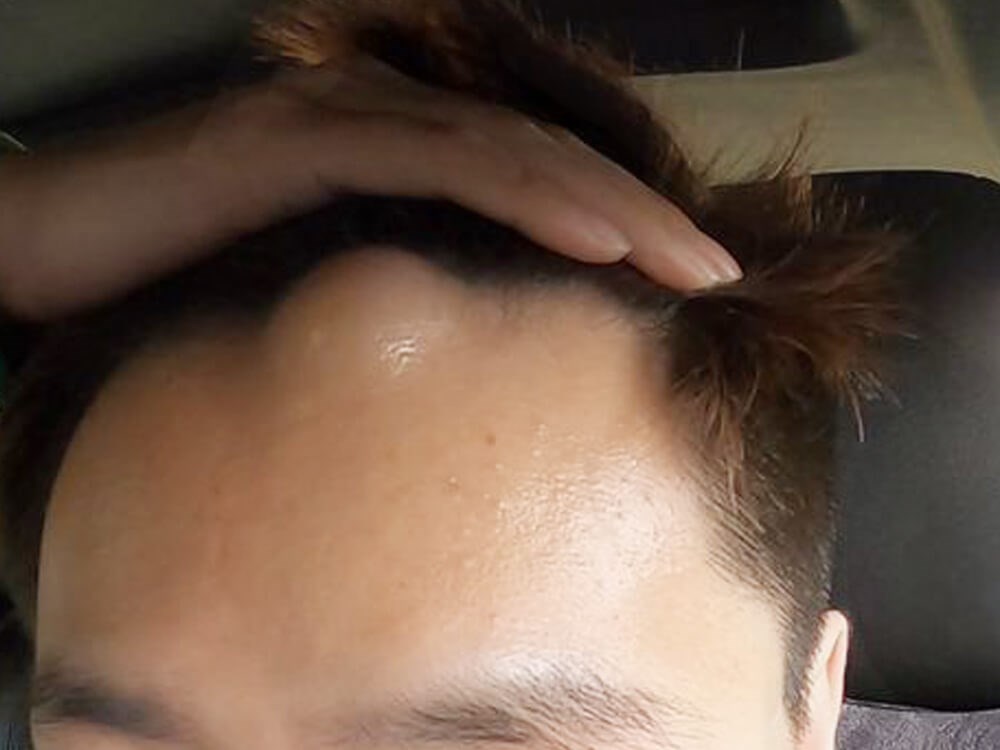 Excision of cyst Before