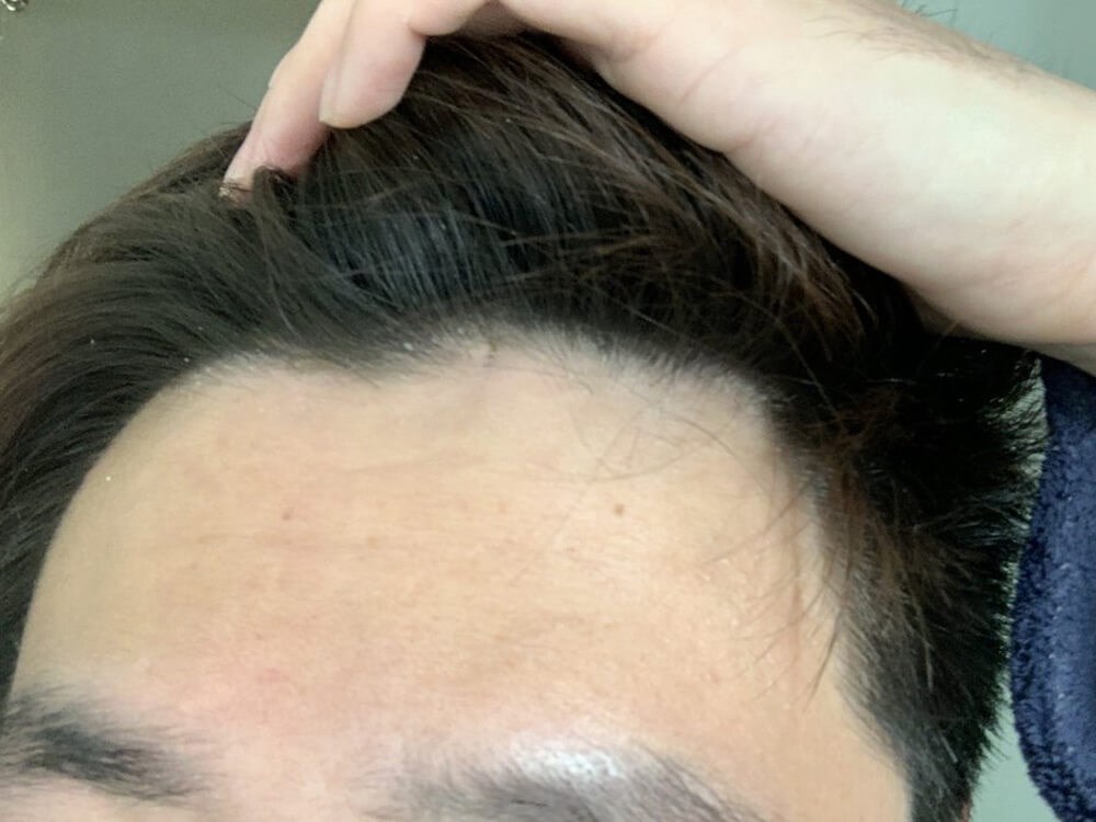 Excision of cyst After