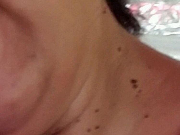 Skin Tag Removal Before