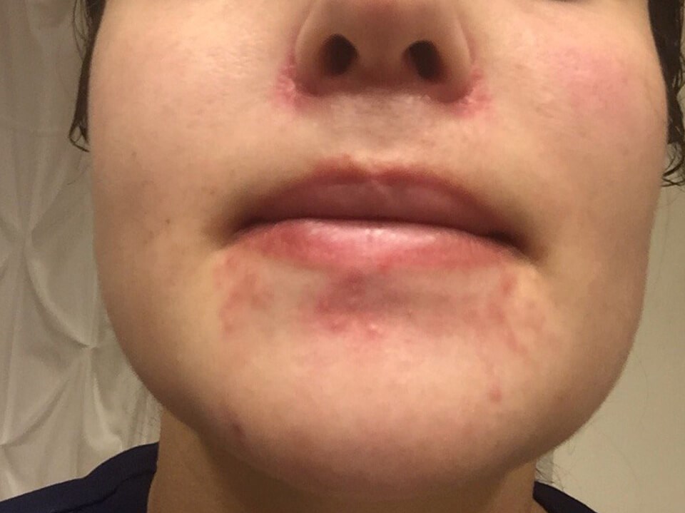 Acne Before