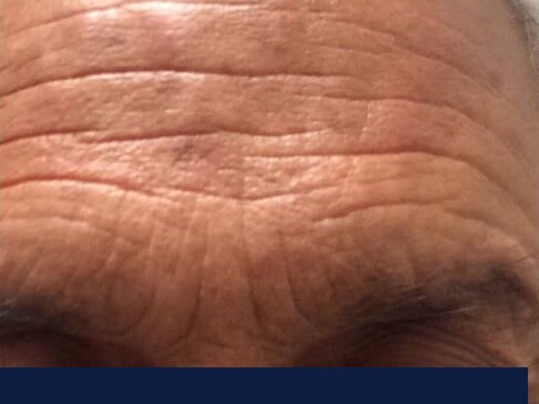 Botox to the forehead Before