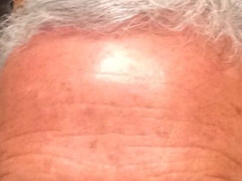 Botox to the forehead After