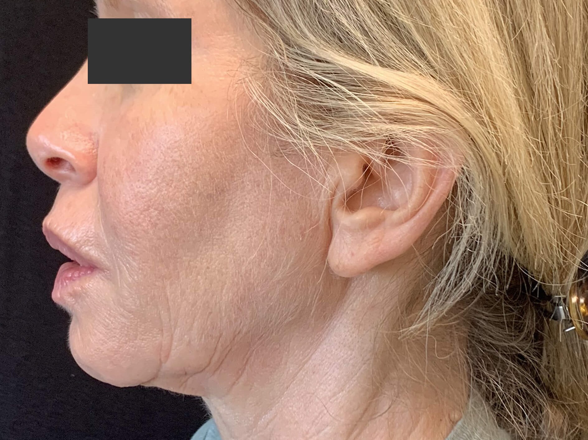 Chin & Jawline Before