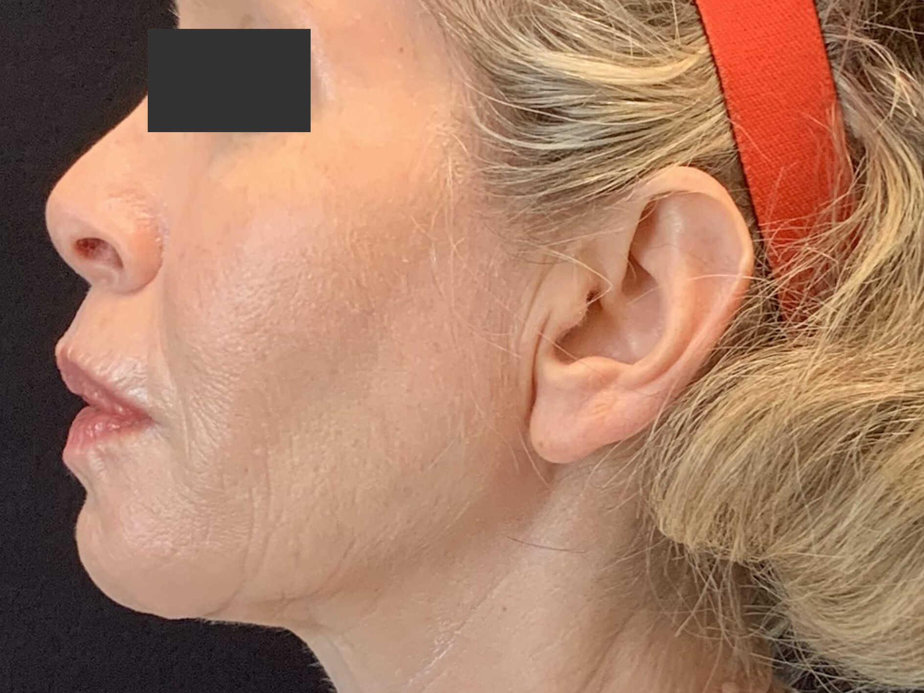 Chin & Jawline After