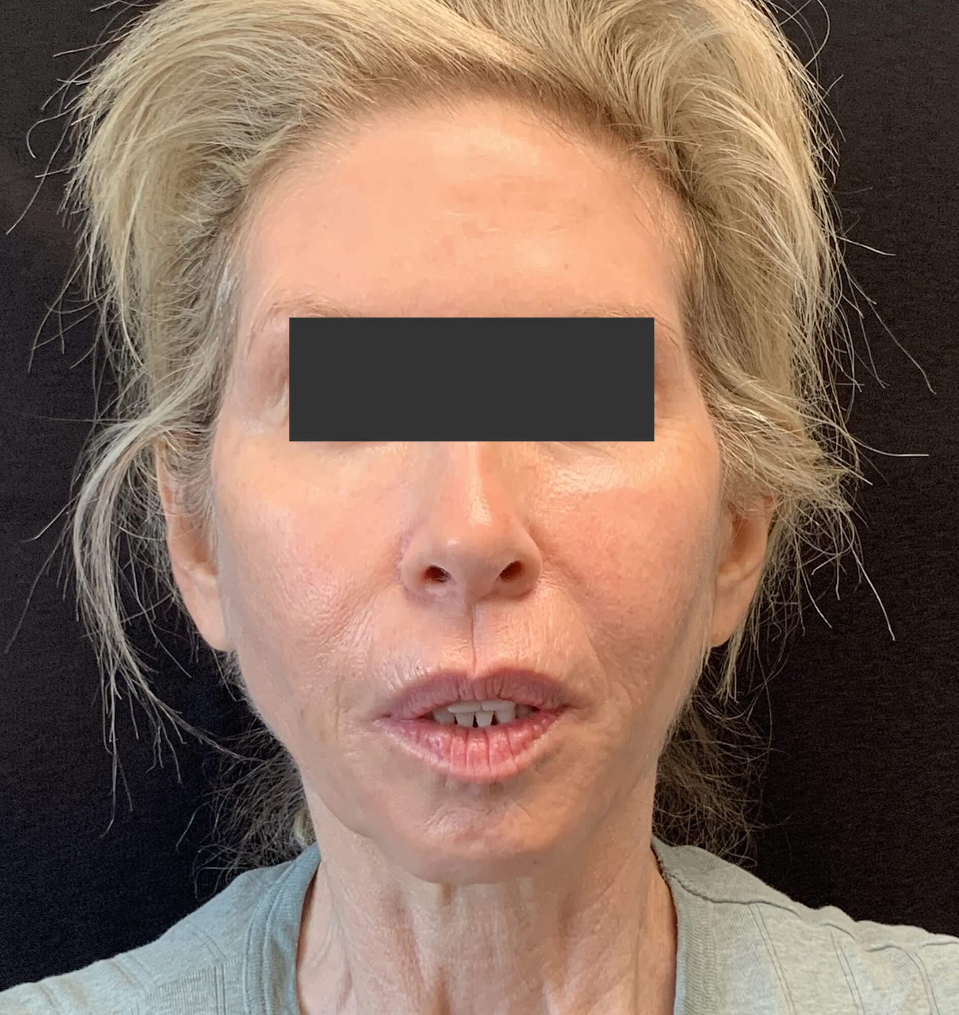 Chin & Jawline Before