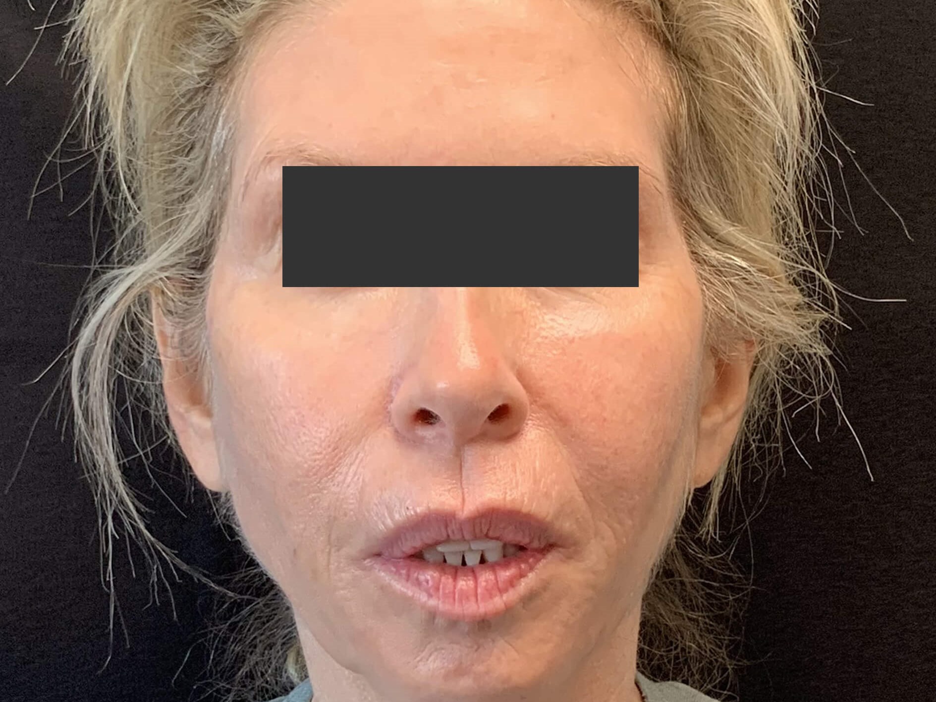 Chin & Jawline Before