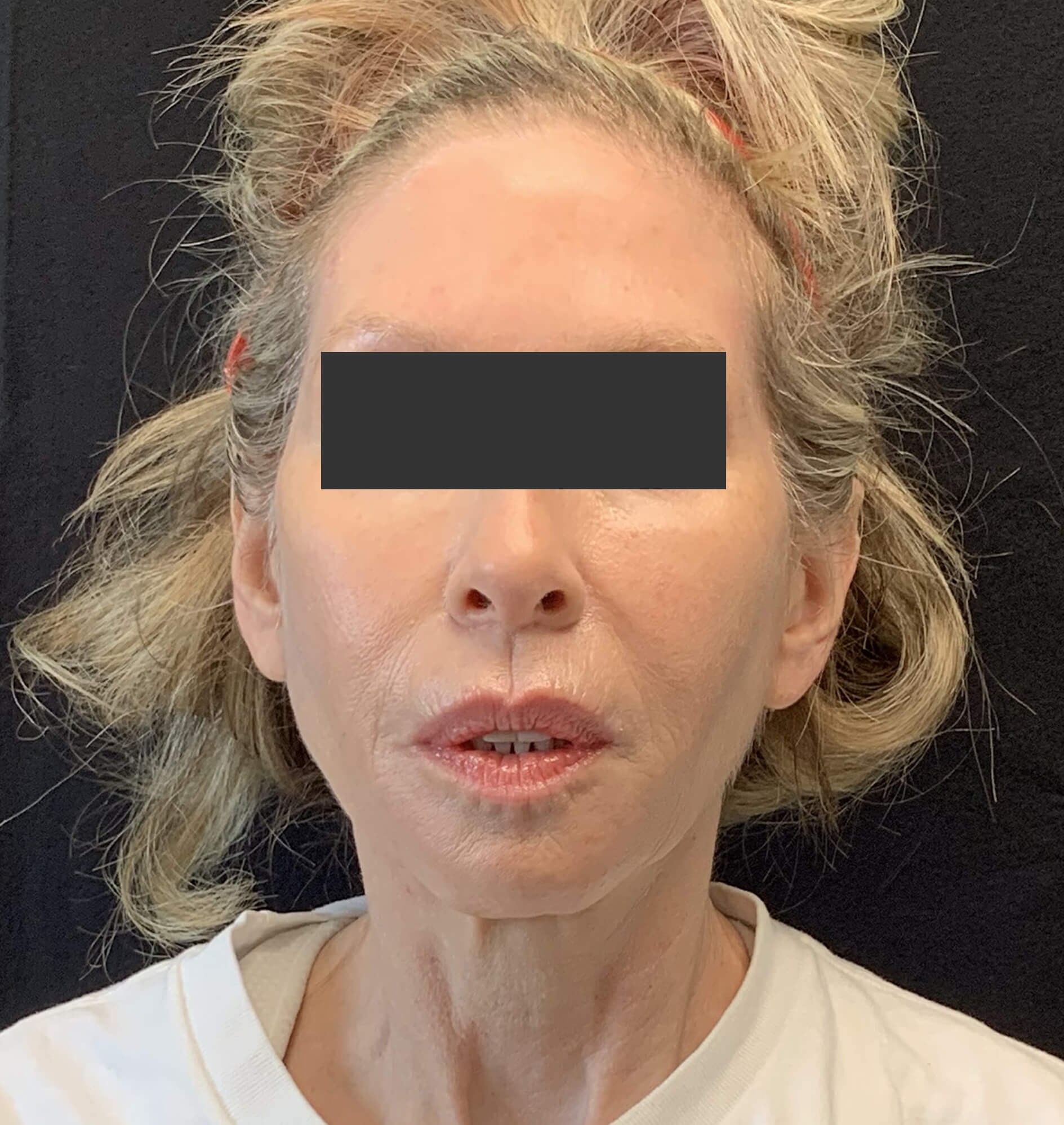 Chin & Jawline After