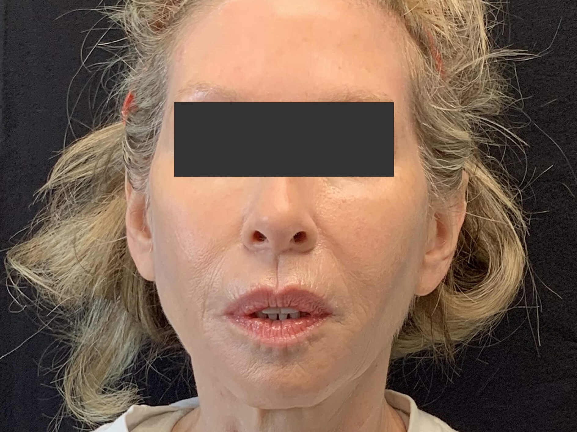 Chin & Jawline After