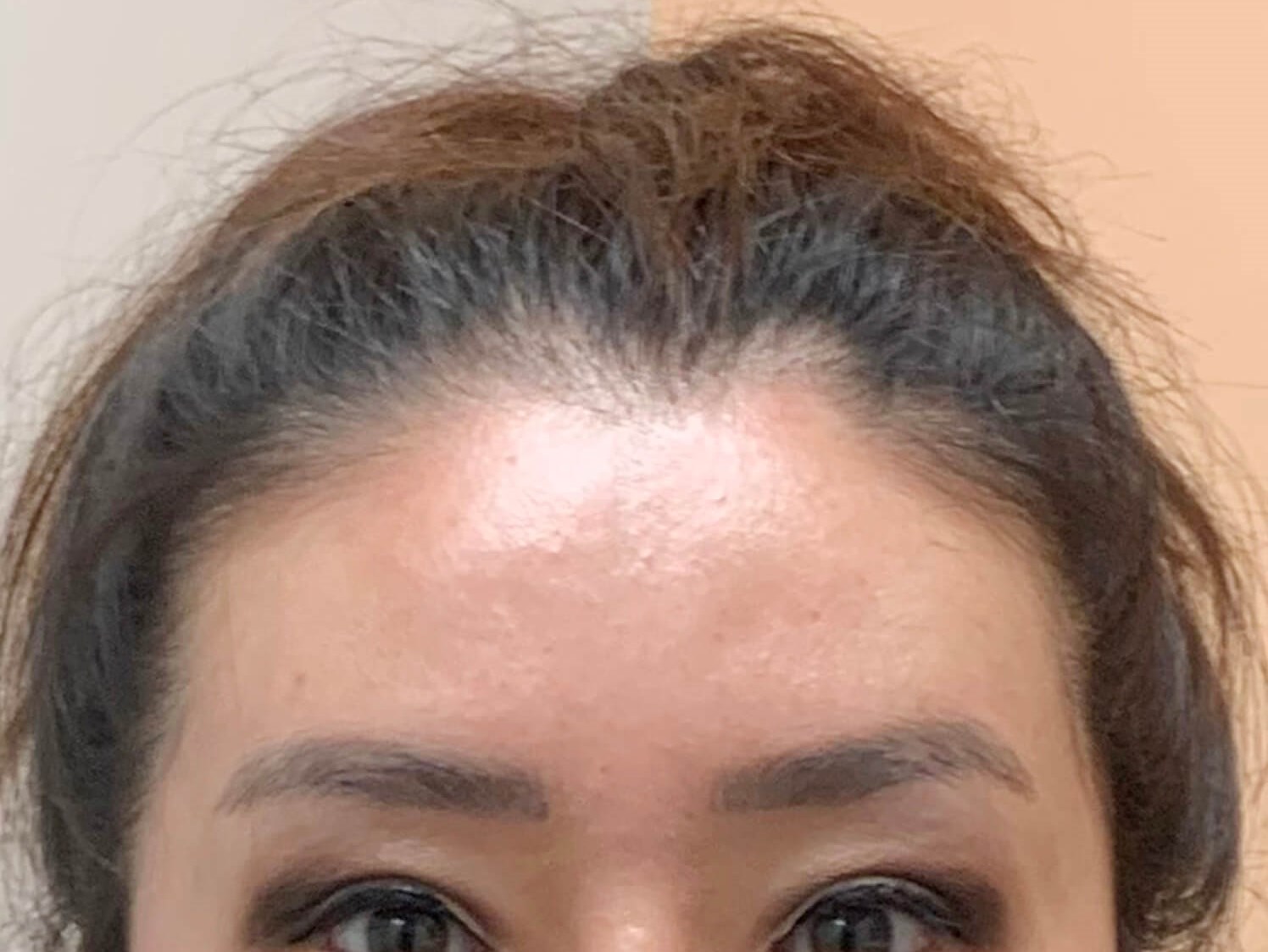 Brow and eyelid lift Before