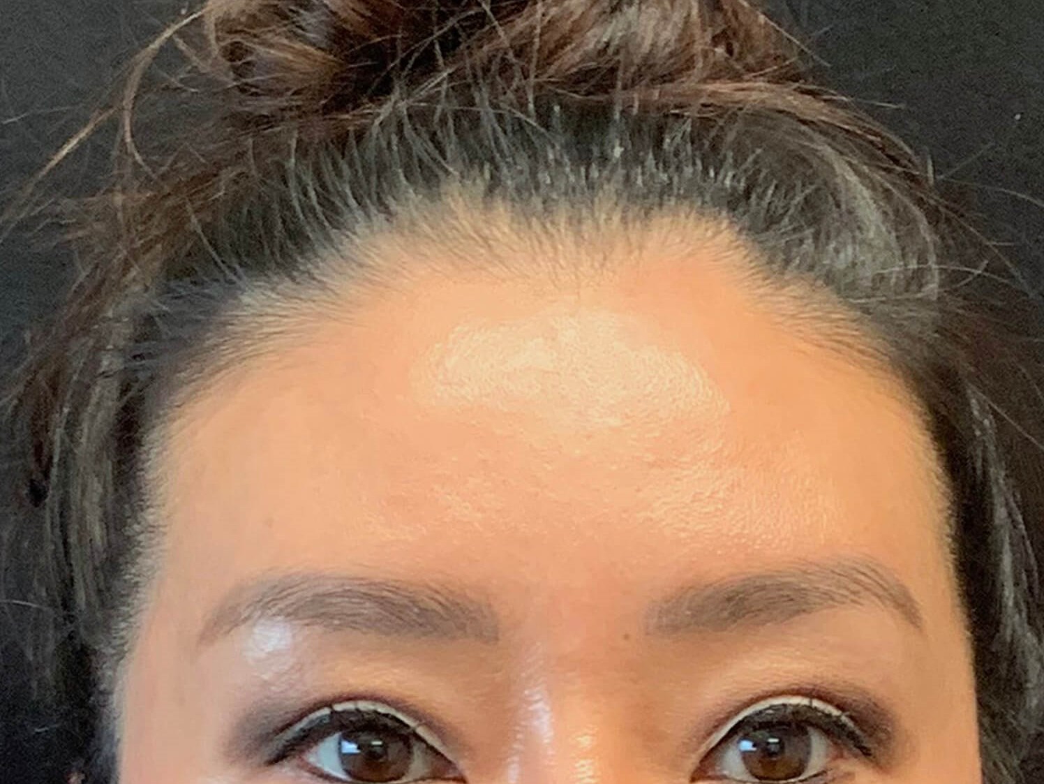 Brow and eyelid lift After