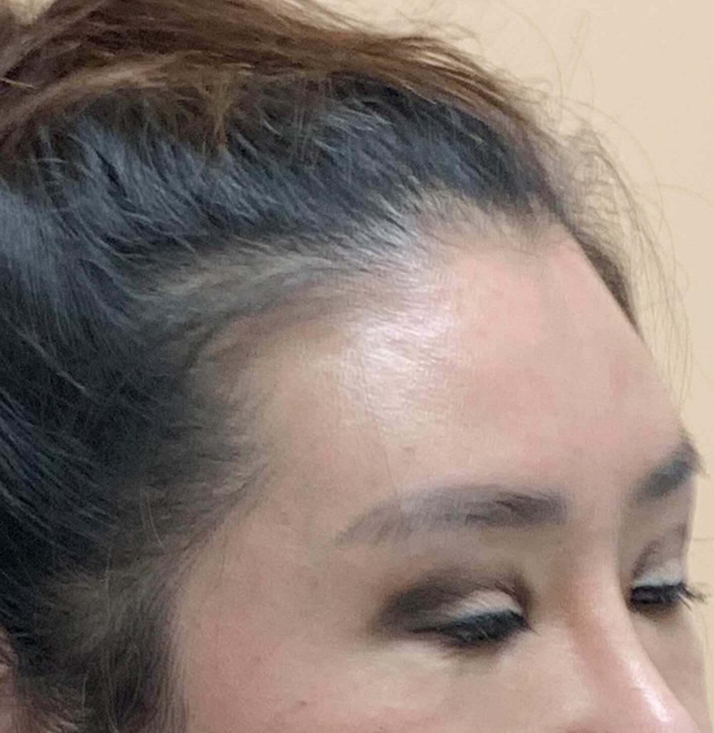 Brow and eyelid lift Before