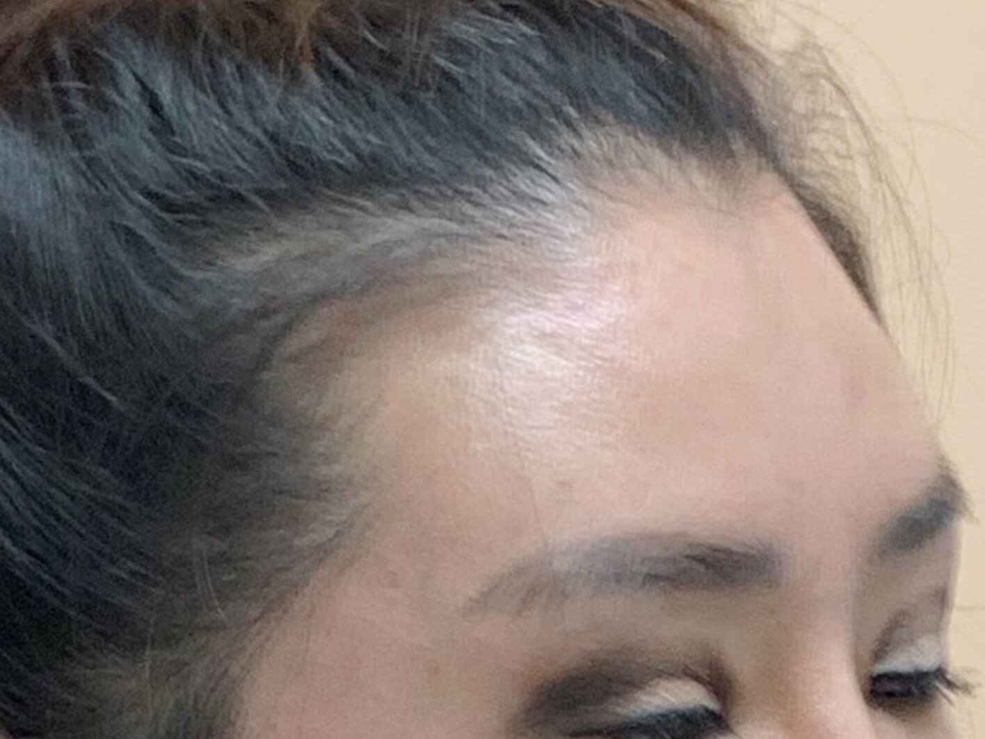 Brow and eyelid lift Before