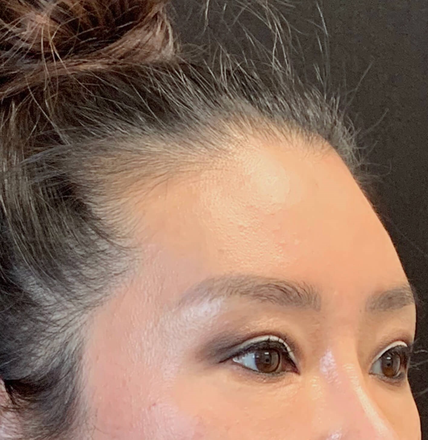 Brow and eyelid lift After