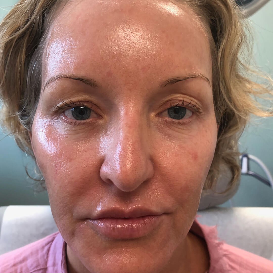 Opus Plasma 45 yo skin refresh Before