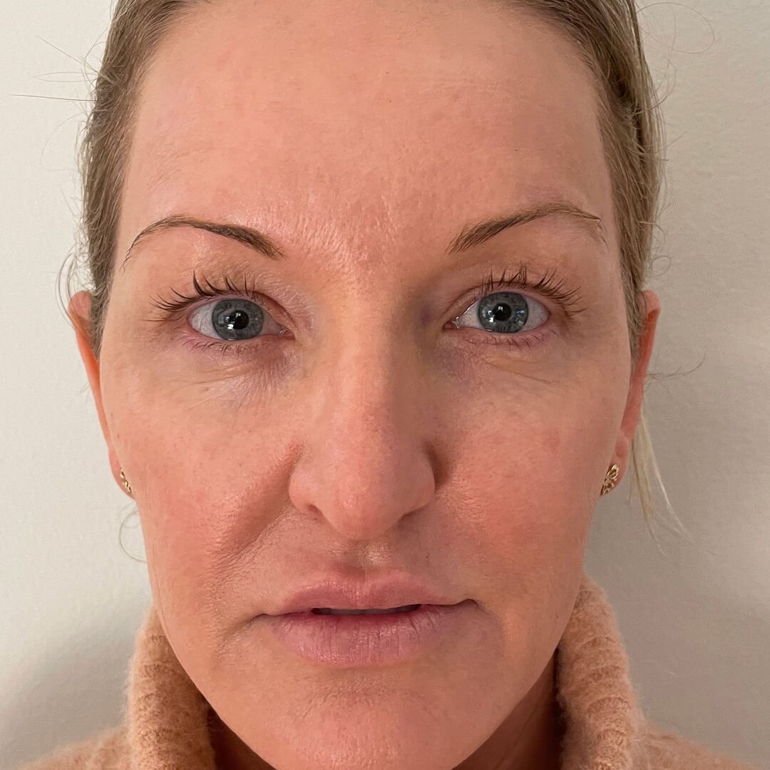 Opus Plasma 45 yo skin refresh After