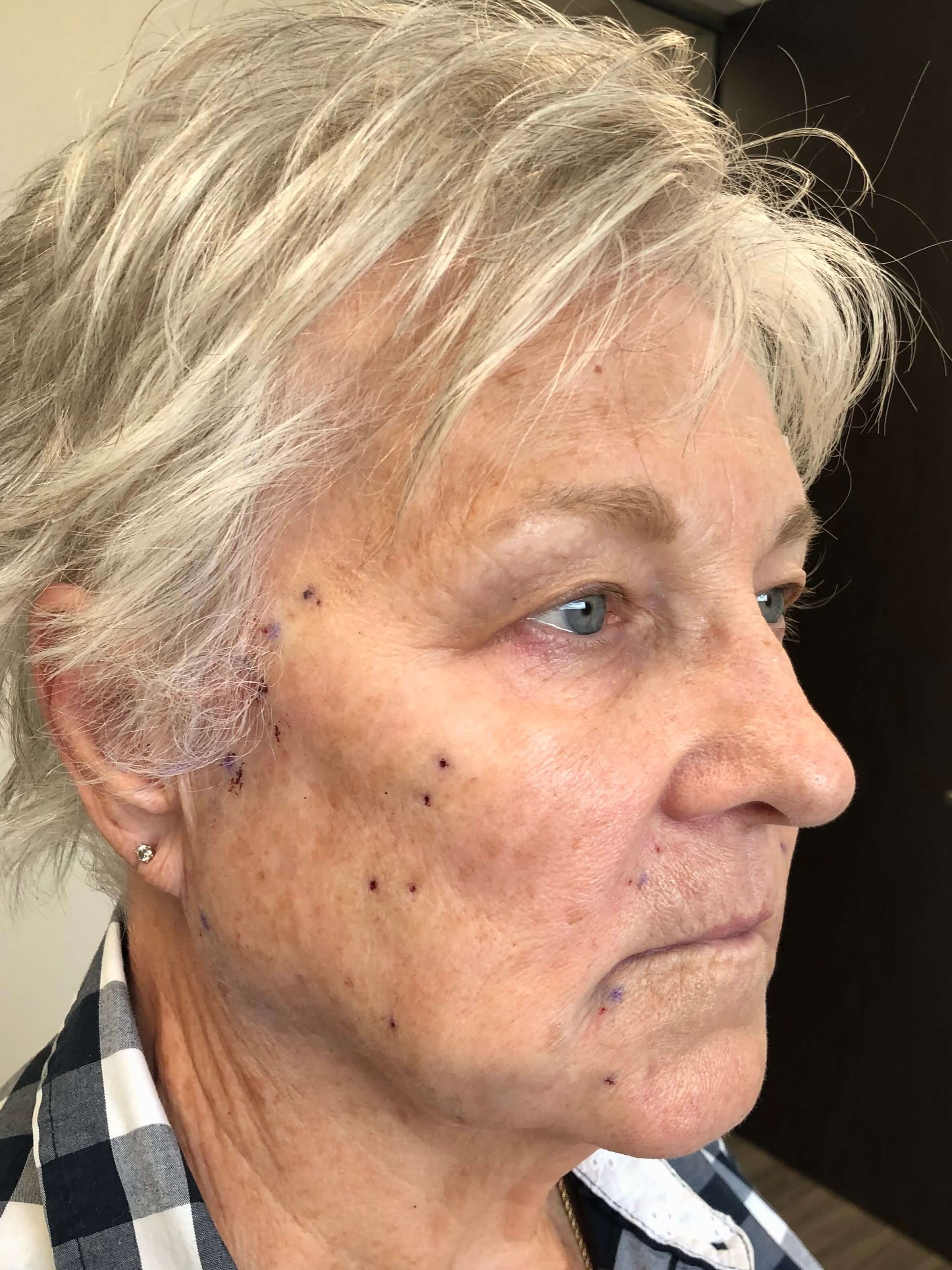 Facelift Without Surgery After