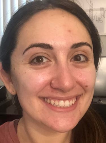 Mole (Right Nose) Removal Before