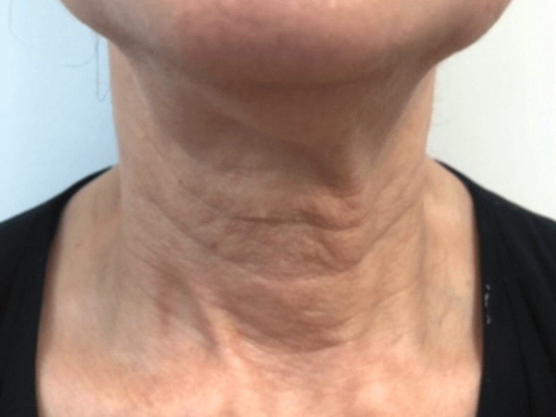 Skin Tightening on Neck Before