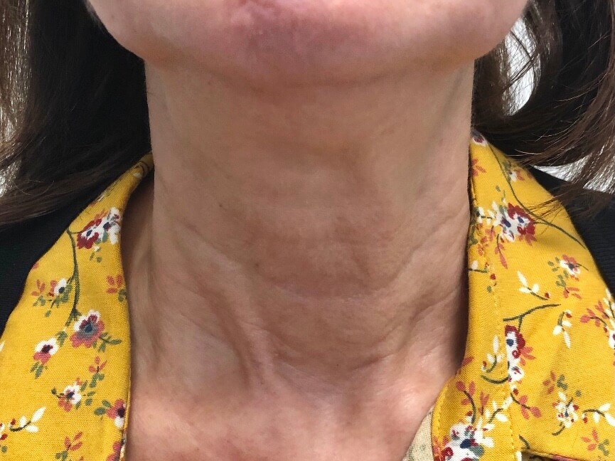 Skin Tightening on Neck After