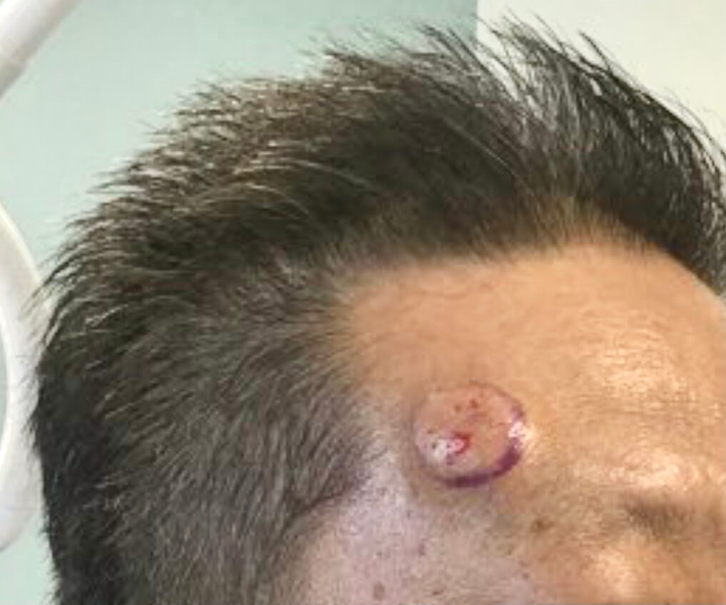 Lipoma Removal Before