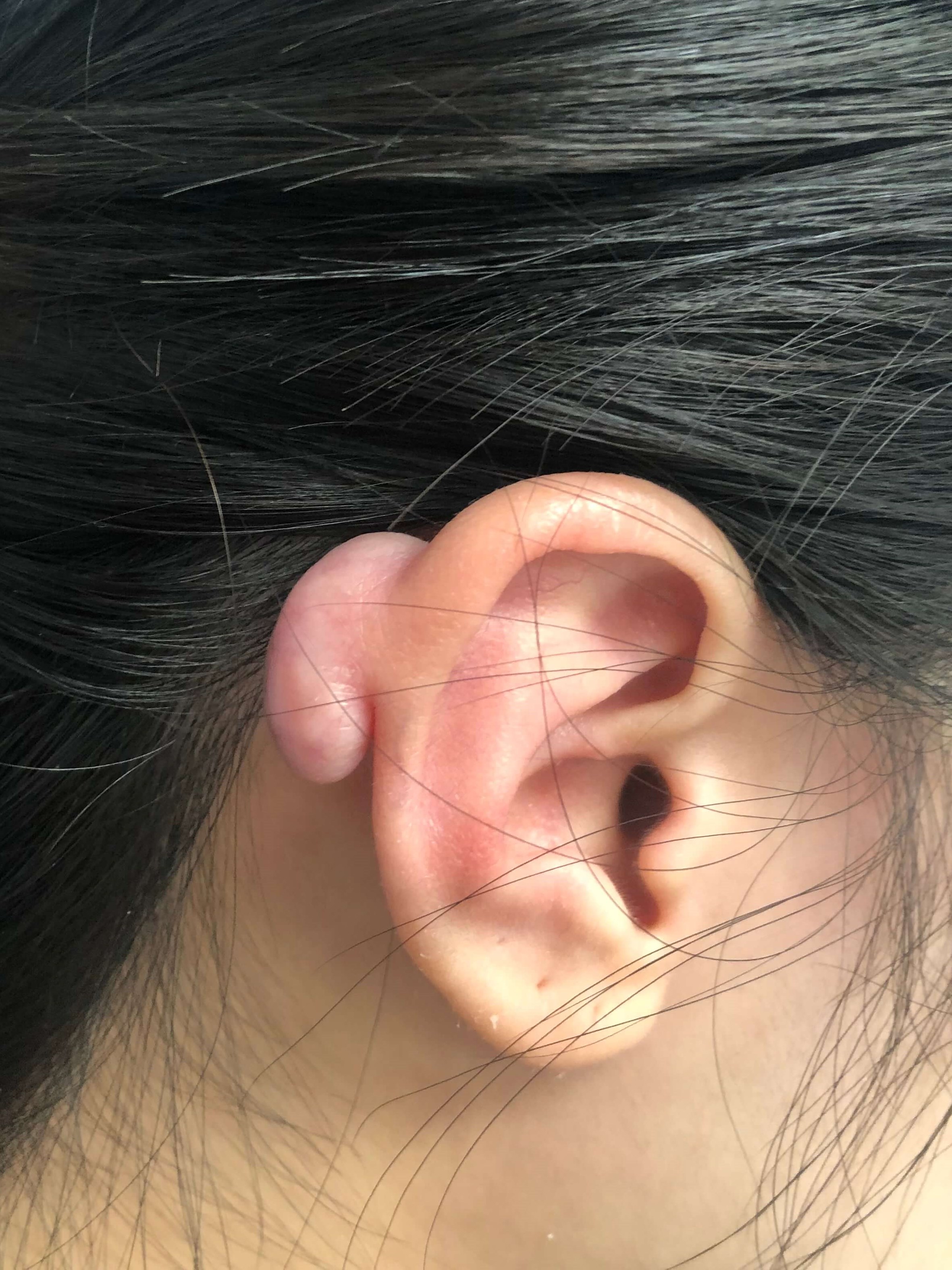 Keloid Removal on Ear Before