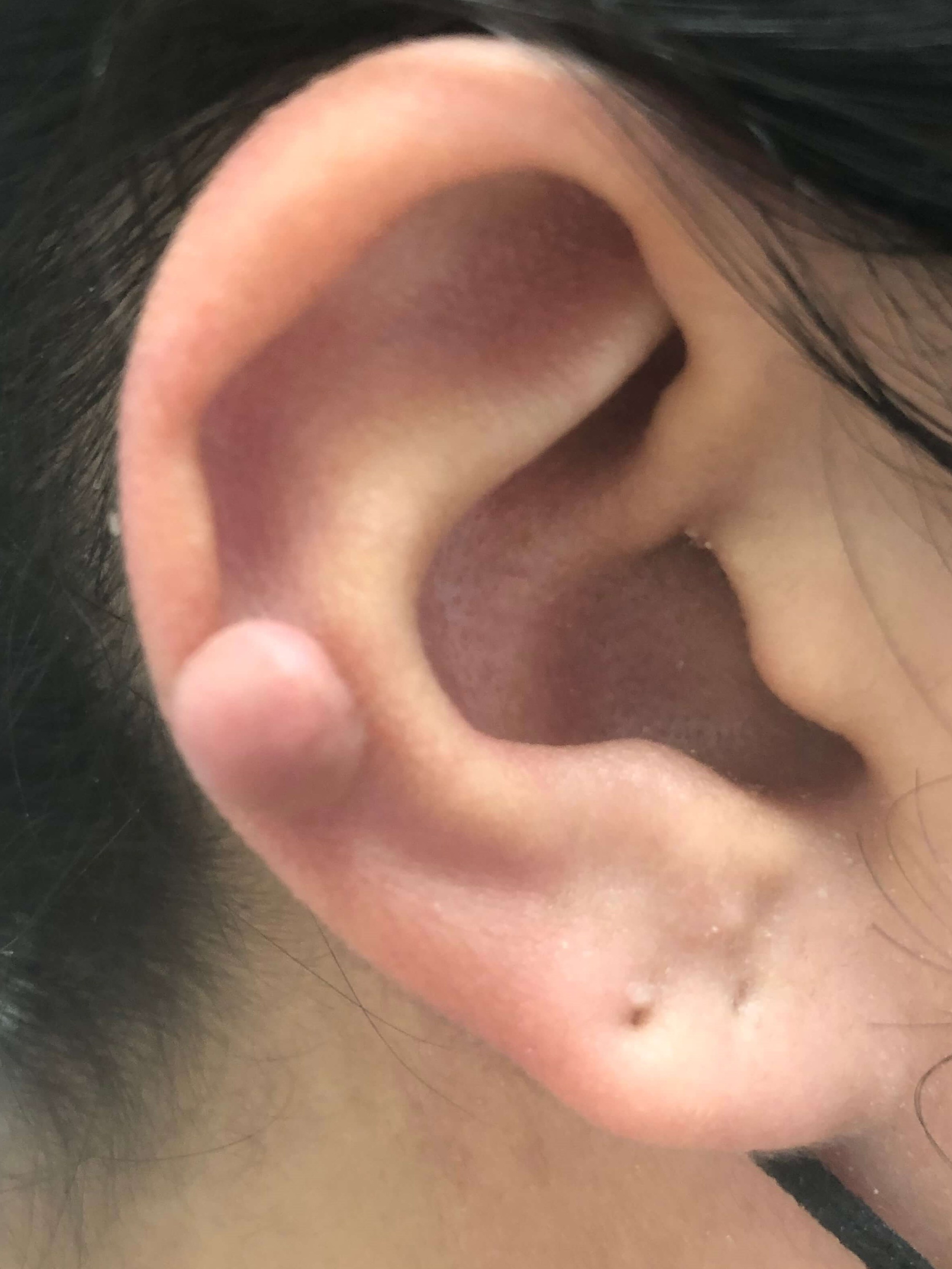 Painless Ear Keloid Removal Before
