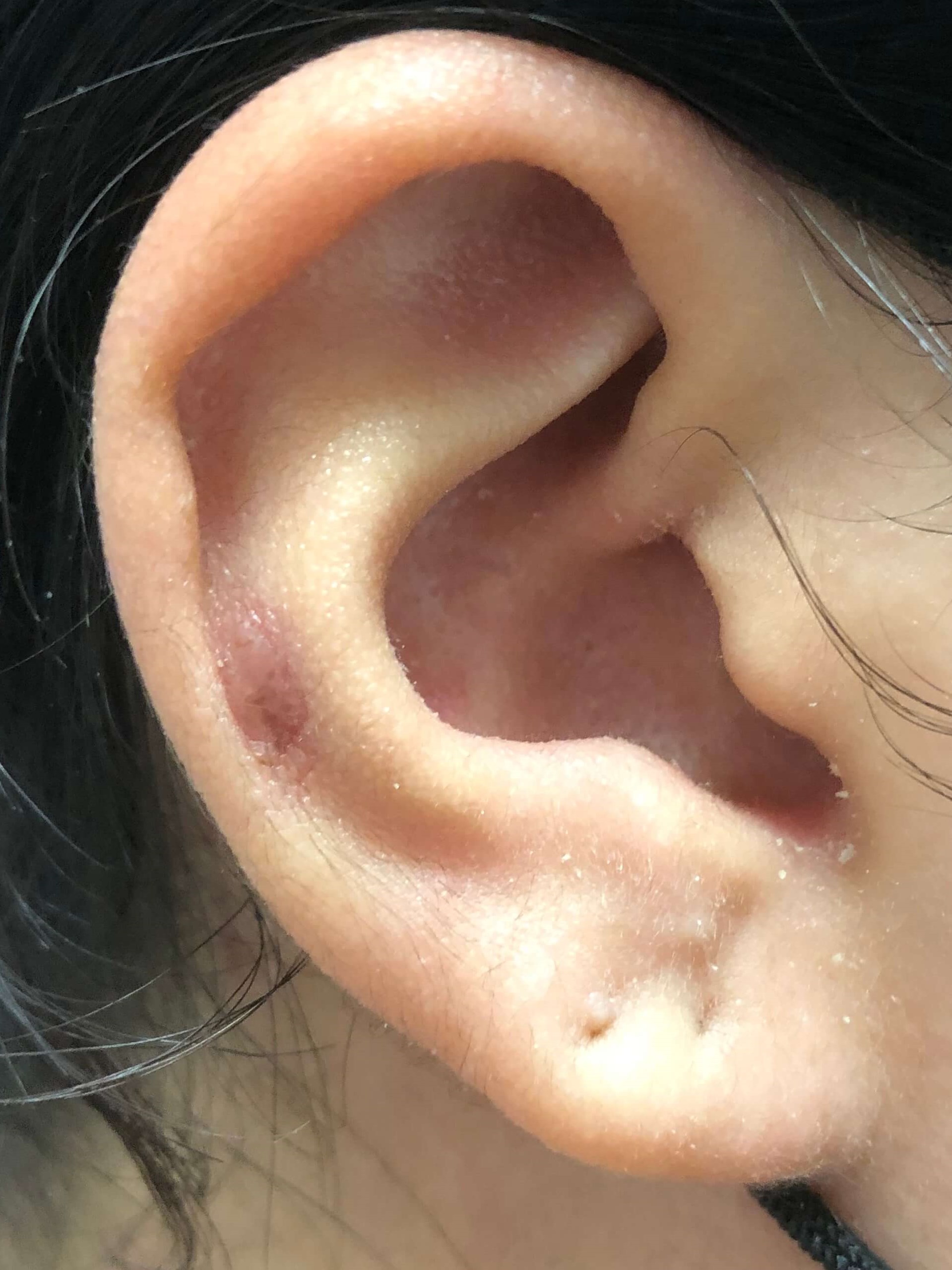 Painless Ear Keloid Removal After